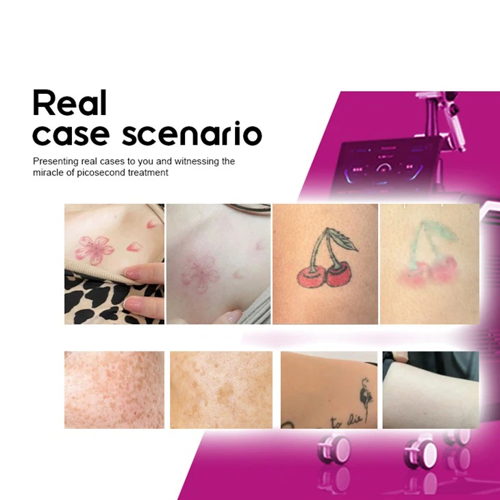 Laser Pigmentation Removal Machine